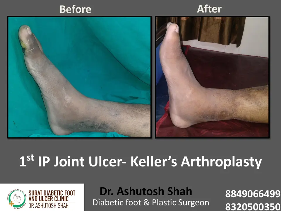 Diabetic Foot  PPT 3 checked by sir.pptx-42.webp